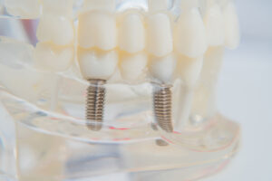 image of see through prosthetic set of teeth explaining what are dental implants and who needs them