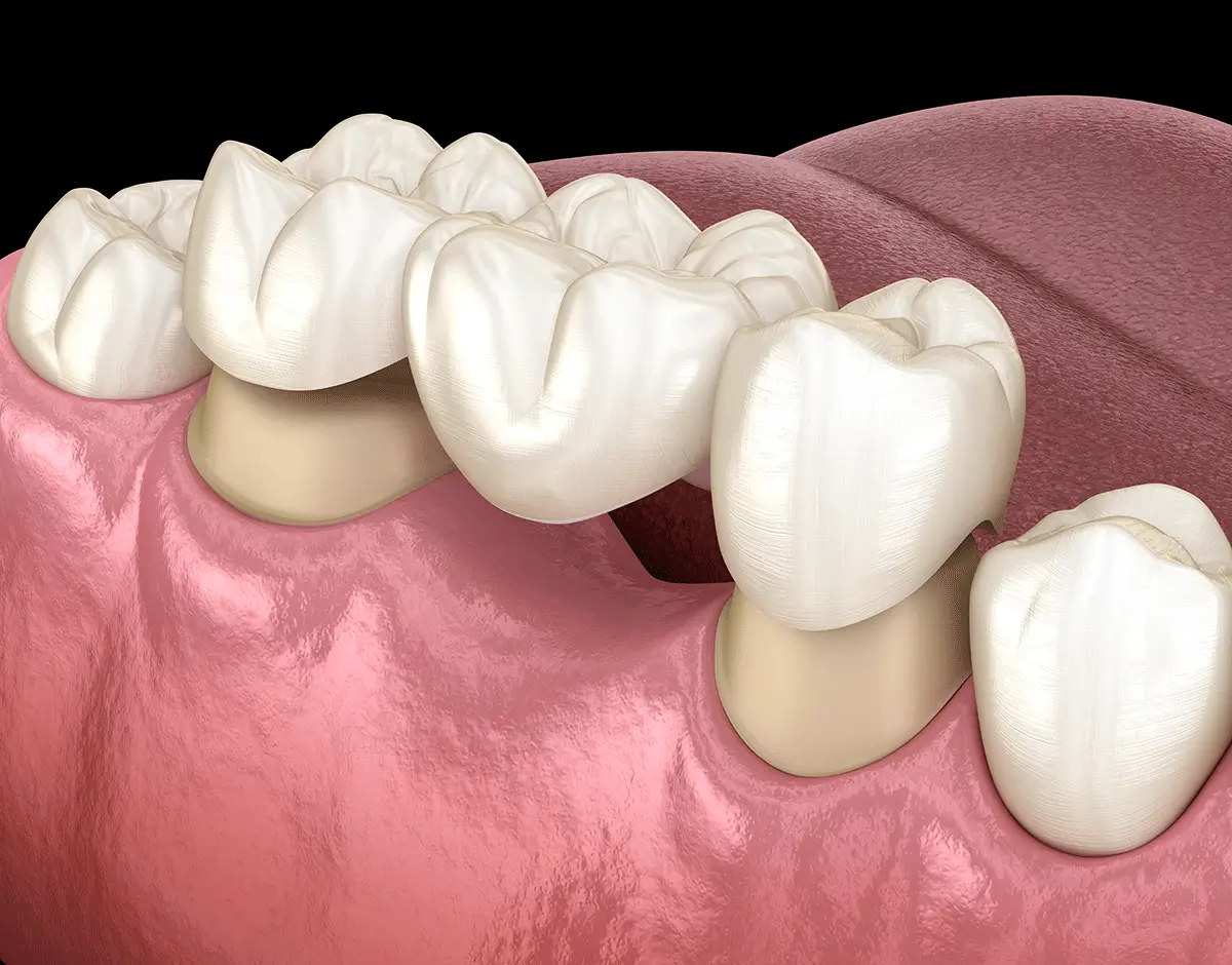 A 3D model of a tooth featuring a crown, representing a dental bridge used in oral restoration