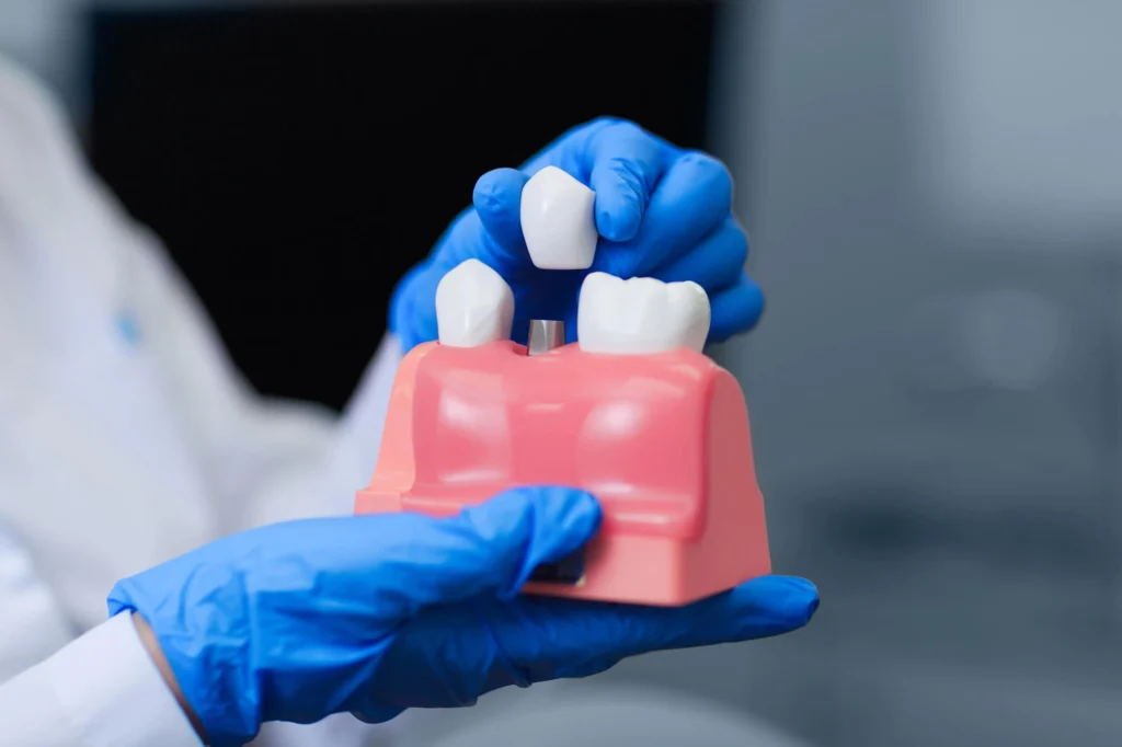Dental Implants in NC