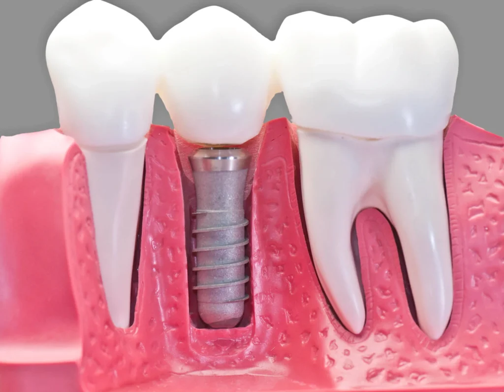 Model of dental implant and crown placement dental crowns in Durham NC
