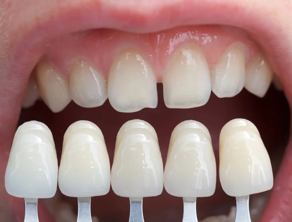 Closeup of teeth with crown color samples dental crowns in Durham NC