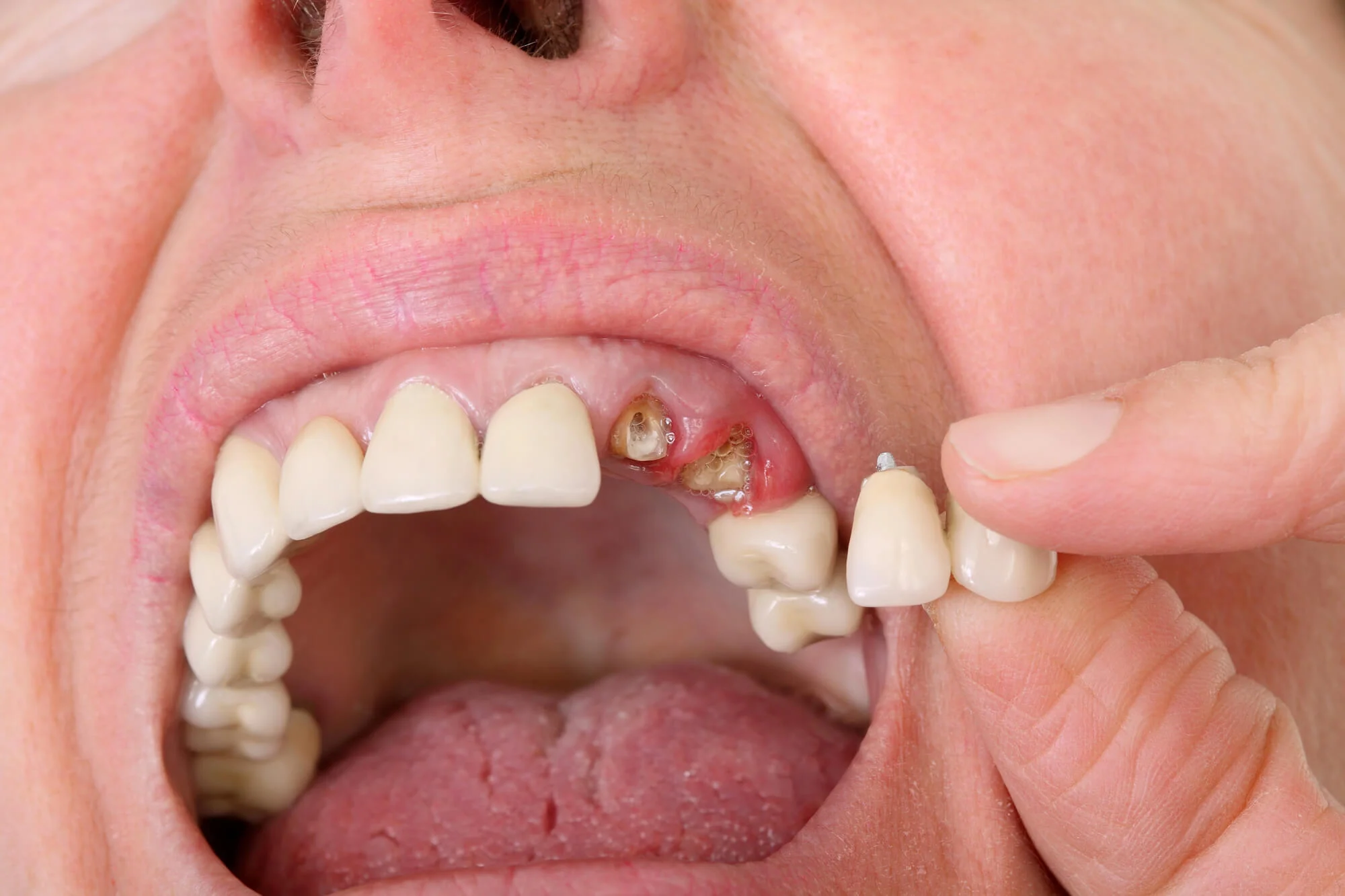 Patient missing teeth before dental bridge dental bridge services