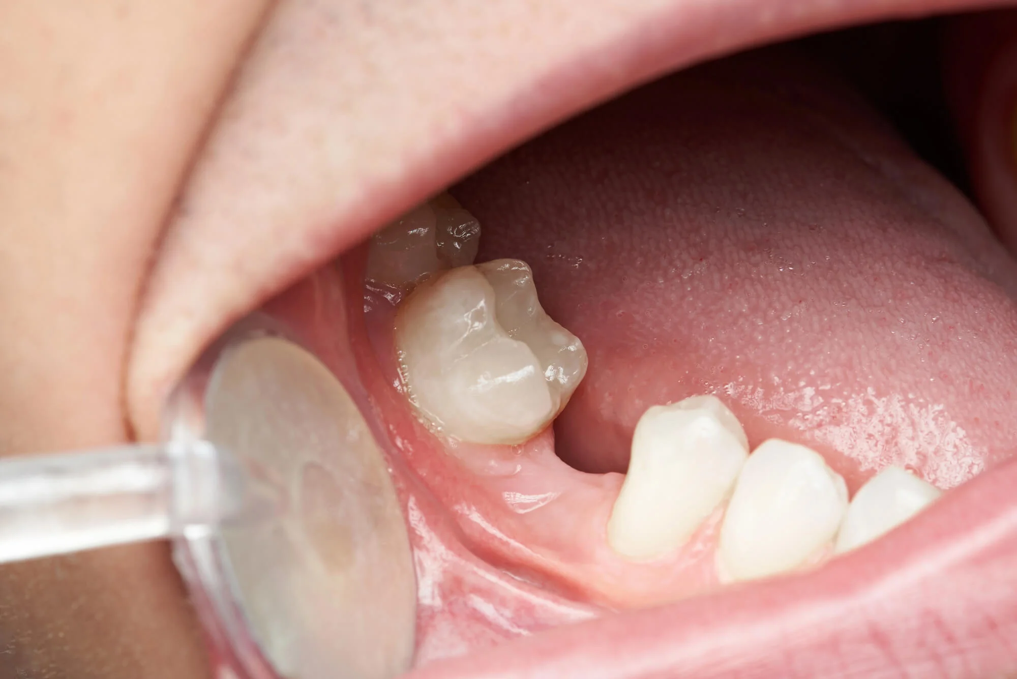 Close-up-gap-where-patient-needs-to-replace-missing-teeth