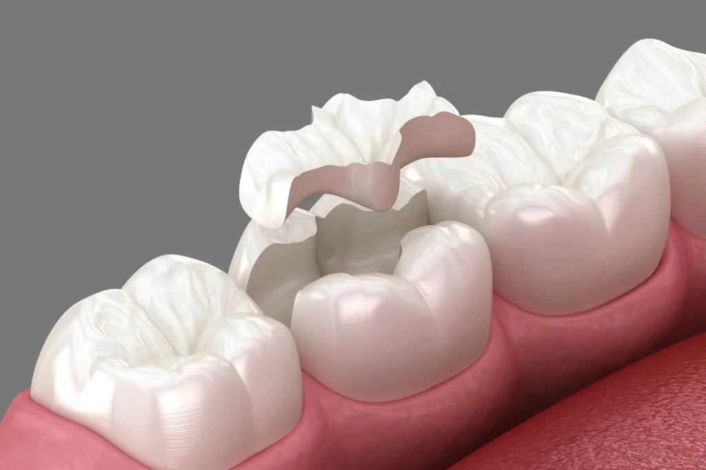Dental crown placement example for tooth restoration options