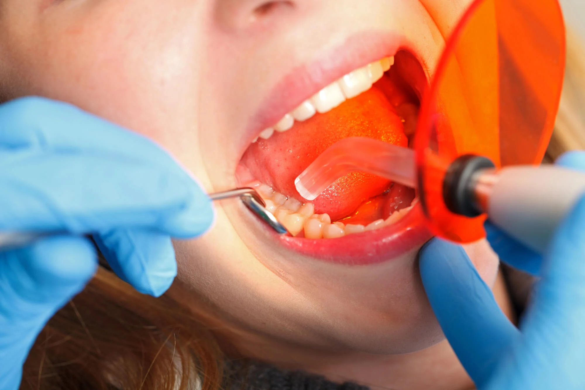 Dentist curing tooth during tooth restoration options treatment