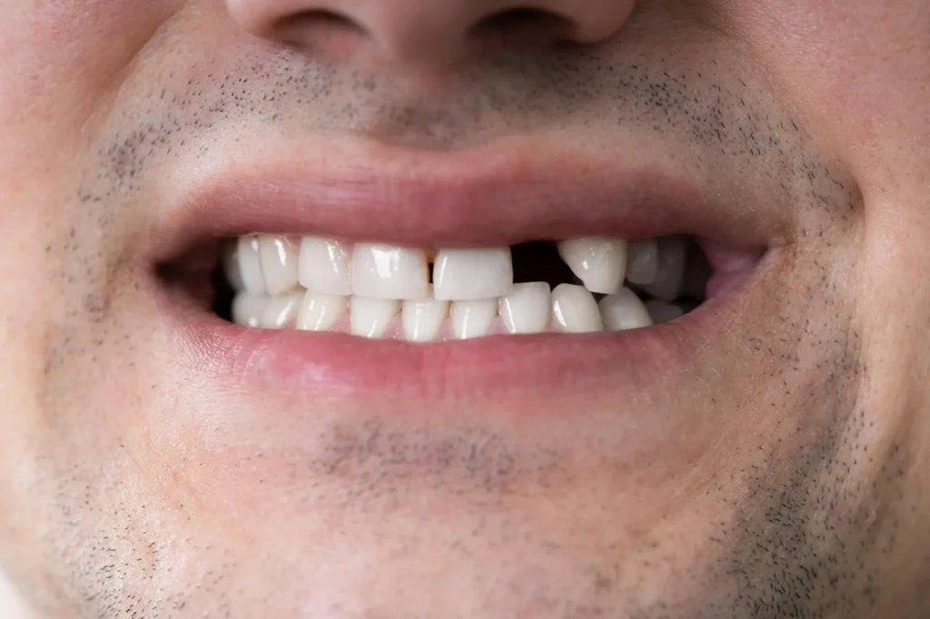 Smile-showing-gap-before-treatment-to-replace-missing-teeth