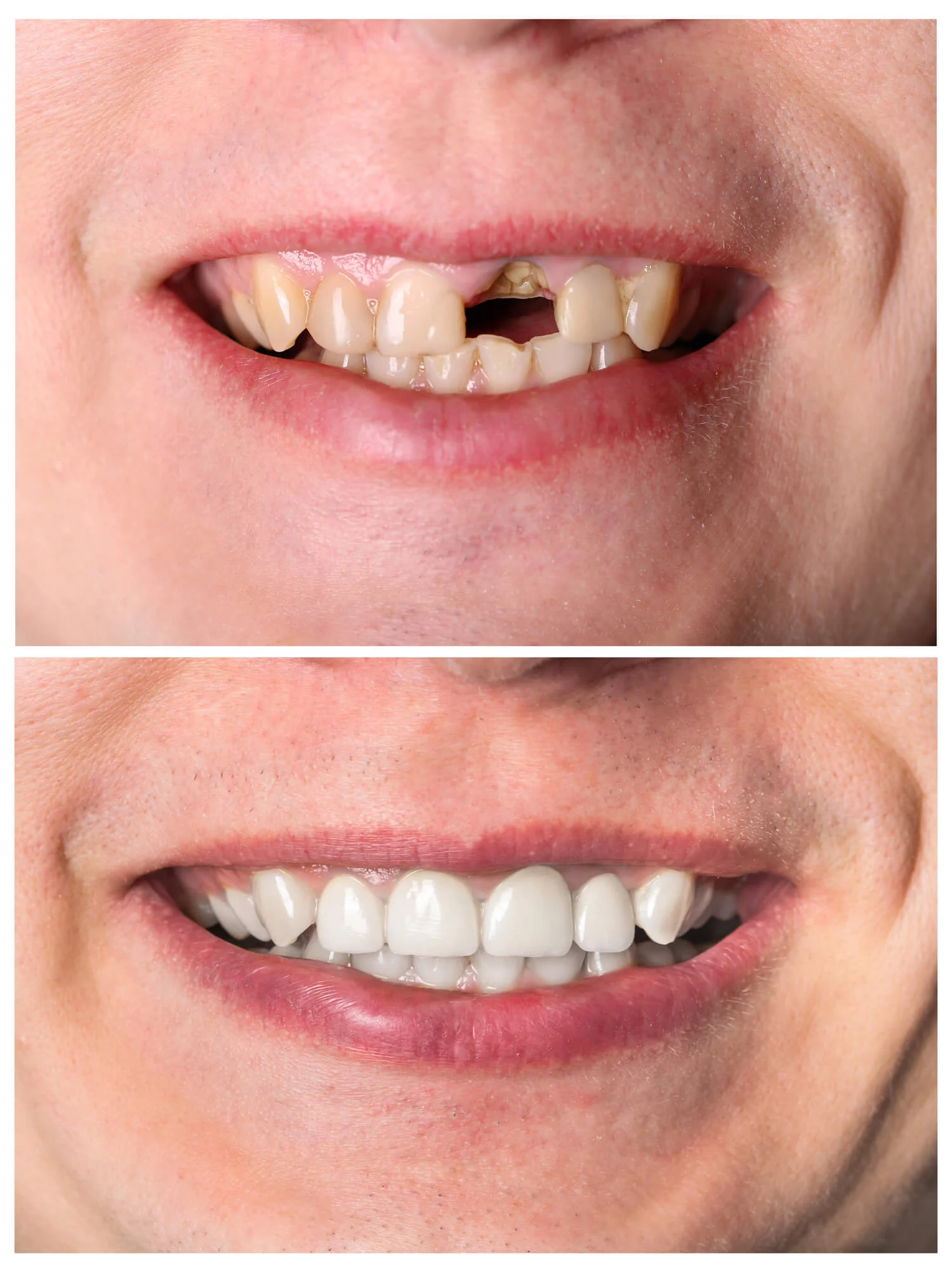 Missing-teeth-smile-dental-restoration-specialist