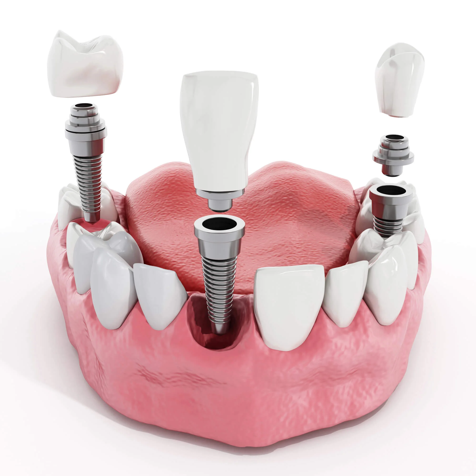 Dental implants in Durham treatment consultation