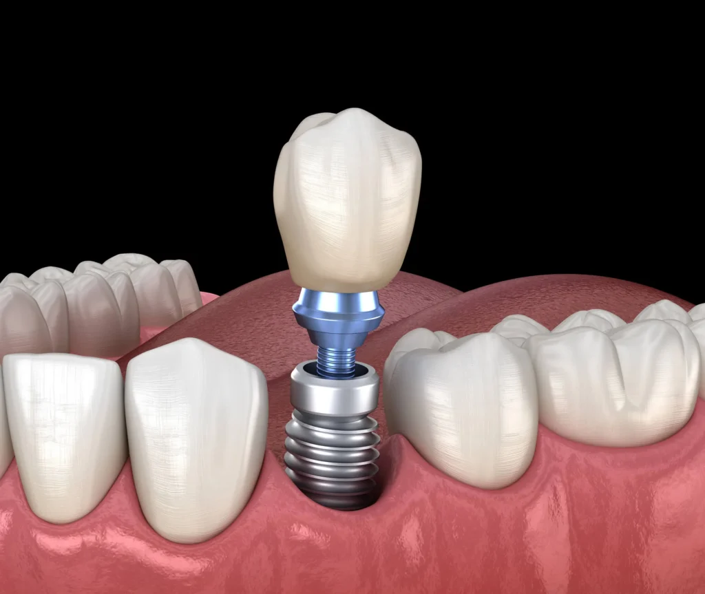 Single dental implant restoration in Durham