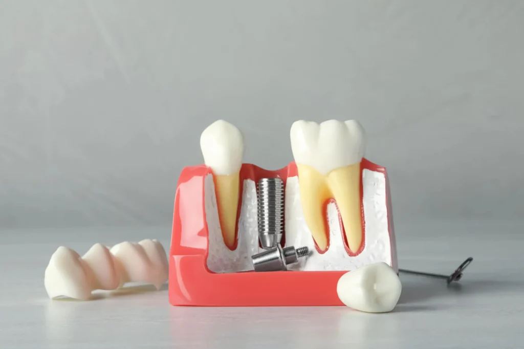 Dental implant model for prosthodontics in Durham