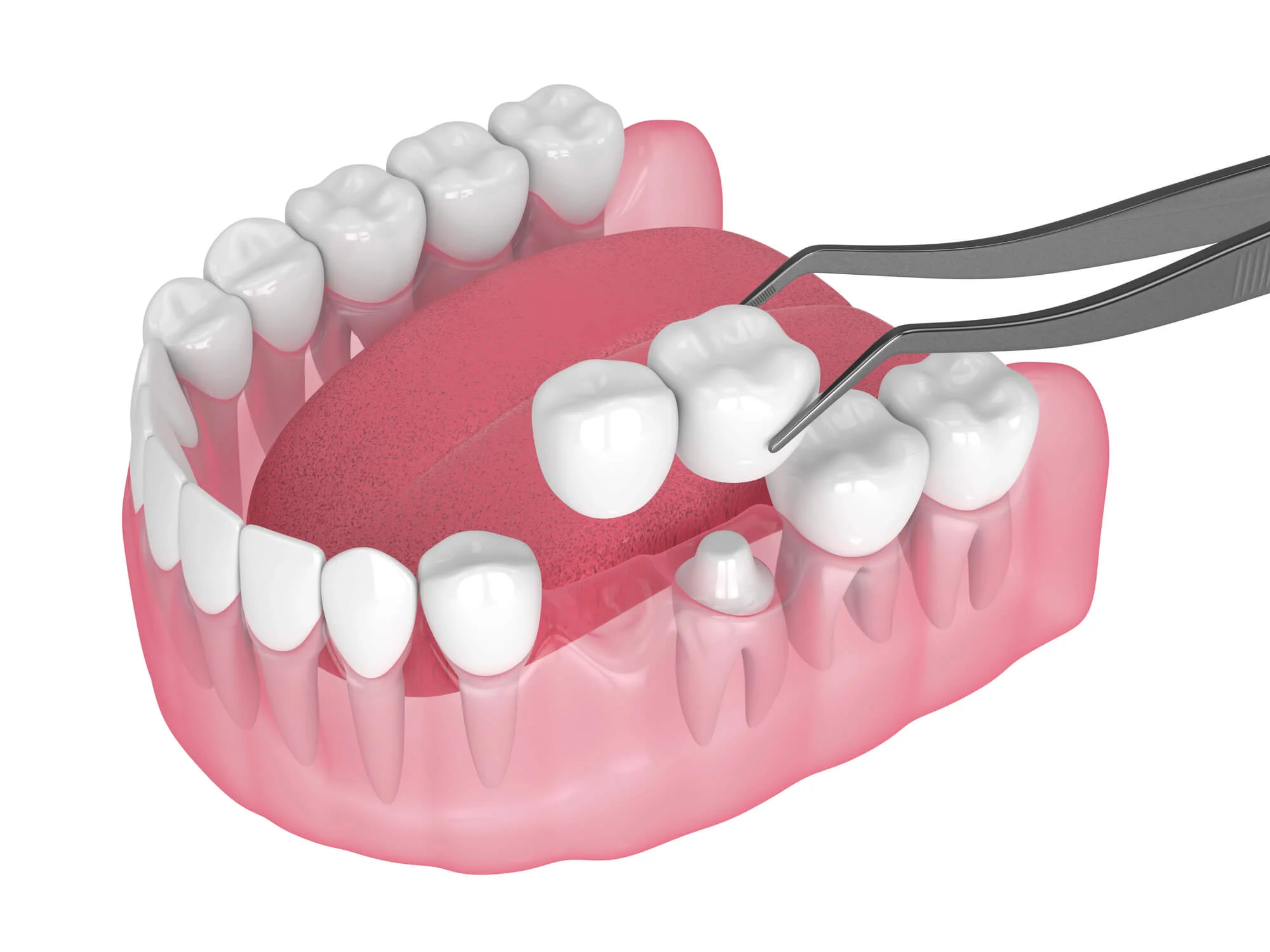 Prosthodontics in Durham replacing missing teeth