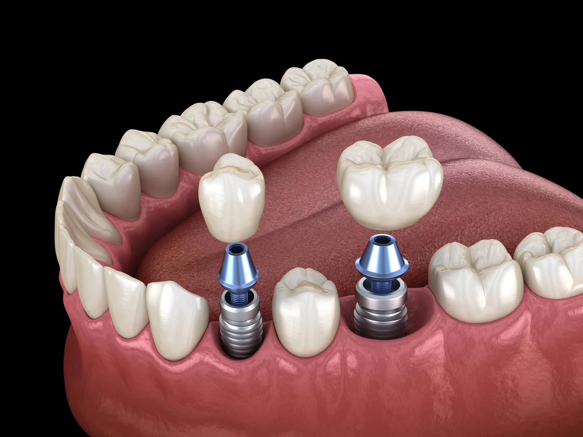 missing teeth solutions durham implants